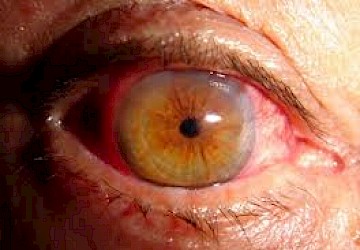 Falta de controlo da diabetes pode provocar retinopatia