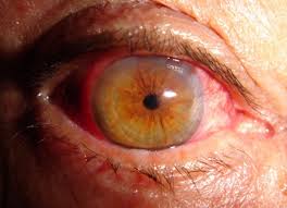 Falta de controlo da diabetes pode provocar retinopatia