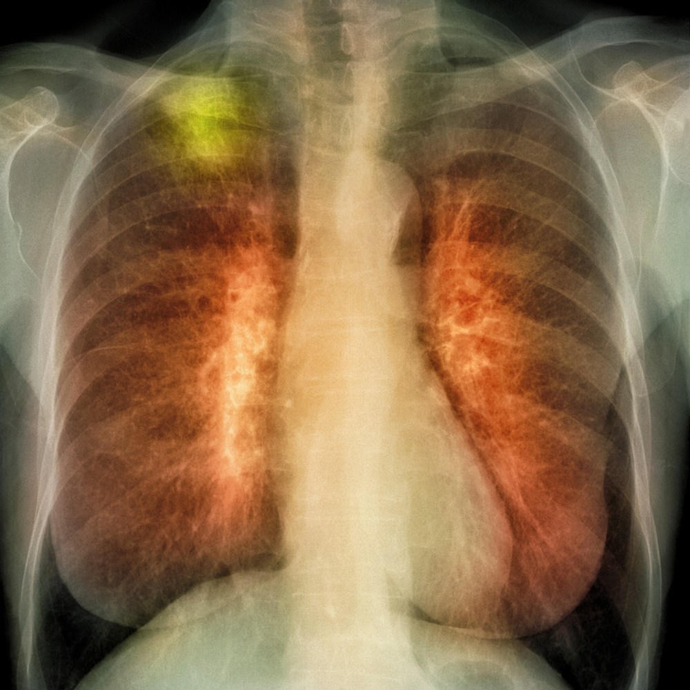 Cancro do pulmão é tumor que mais preocupa os portugueses