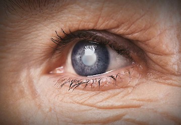 Perda de visão por glaucoma poderá ser evitada com aplicação de células estaminais do cordão umbilical, revela novo estudo