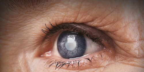 Perda de visão por glaucoma poderá ser evitada com aplicação de células estaminais do cordão umbilical, revela novo estudo